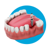 Single-Dental-implant.png