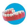 Single-implant-with-crown.png